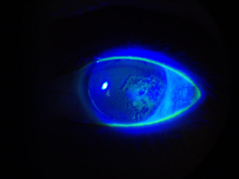 Corneal Abrasion - Diseases Pictures